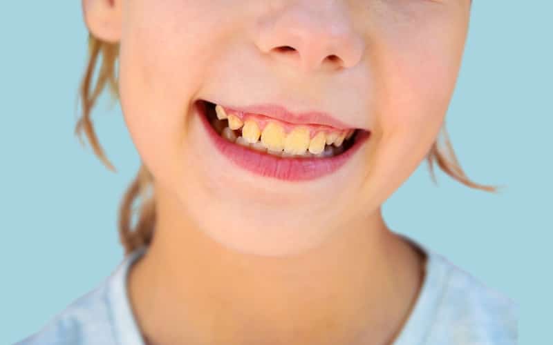 what are the causes of yellow teeth in children