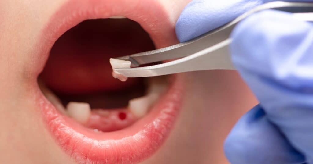 the signs that make tooth extraction necessary for kids